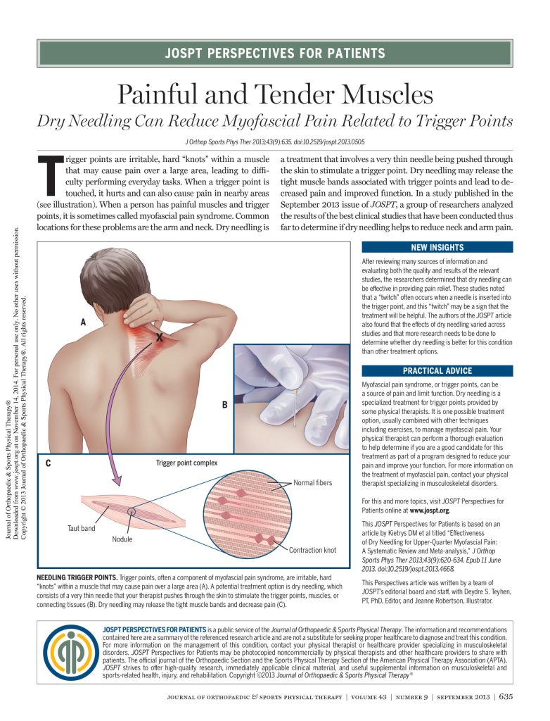dry-needling-can-reduce-trigger-points